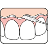 تصویر  نخ دندان مخصوص بریج و ایمپلنت تپه 30 عددی